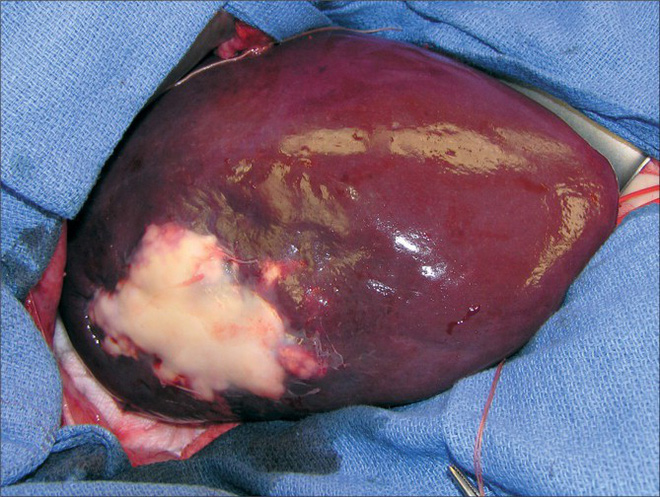 5 nhóm người rất dễ bị bệnh ung thư gan tấn công: Khi phát hiện bệnh thường đã quá muộn-1