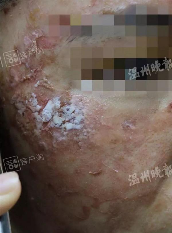 Hãi hùng với làn da lở loét vì sử dụng mặt nạ giấy, tất cả cũng chỉ tại ham rẻ-2