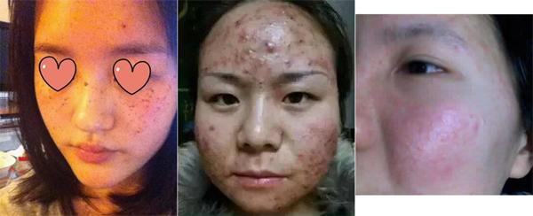 Hãi hùng với làn da lở loét vì sử dụng mặt nạ giấy, tất cả cũng chỉ tại ham rẻ-4