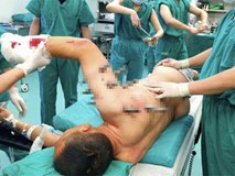 Sống sót thần kỳ sau khi bị 10 chiếc đinh dài 30 cm xuyên thủng người Sống sót thần kỳ sau khi bị 10 chiếc đinh dài 30 cm xuyên thủng người