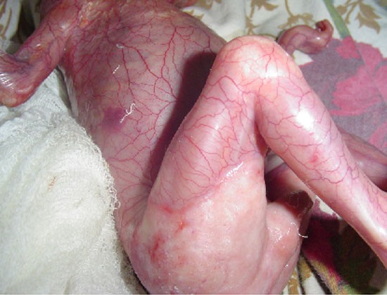 Bé sơ sinh đẻ ra không có da chỉ vì mẹ uống nhầm loại thuốc này khi mang thai-2