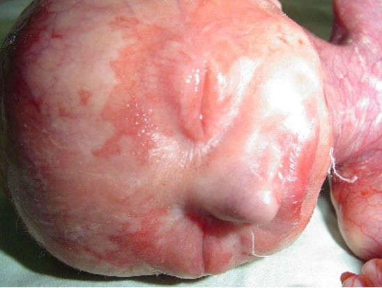 Bé sơ sinh đẻ ra không có da chỉ vì mẹ uống nhầm loại thuốc này khi mang thai-1