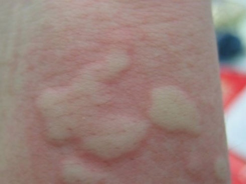 Đau đầu tưởng cúm, đi khám mới phát hiện não đang trôi xuống” cổ-1