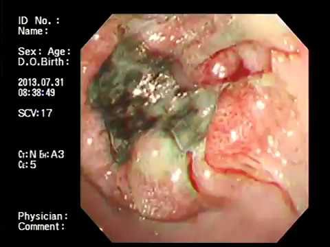 Đau vị trí này cảnh báo ung thư dạ dày cần đi kiểm tra ngay-2