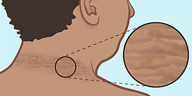 Cô bé 14 tuổi phát hiện mình mắc bệnh tiểu đường nhờ một dấu hiệu lạ ở quanh vùng cổ-3