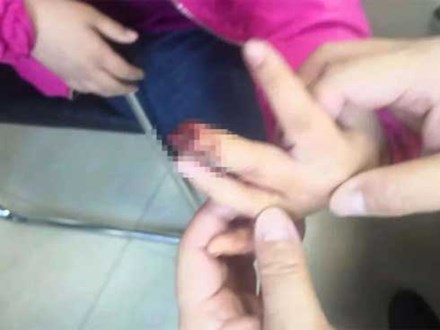 Bé gái 9 tuổi phải cưa ngón tay vì cách sơ cứu sai lầm của bà nội sau khi bị kẹt tay vào cửa