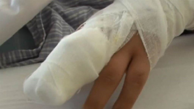 Bé gái 9 tuổi phải cưa ngón tay vì cách sơ cứu sai lầm của bà nội sau khi bị kẹt tay vào cửa-3