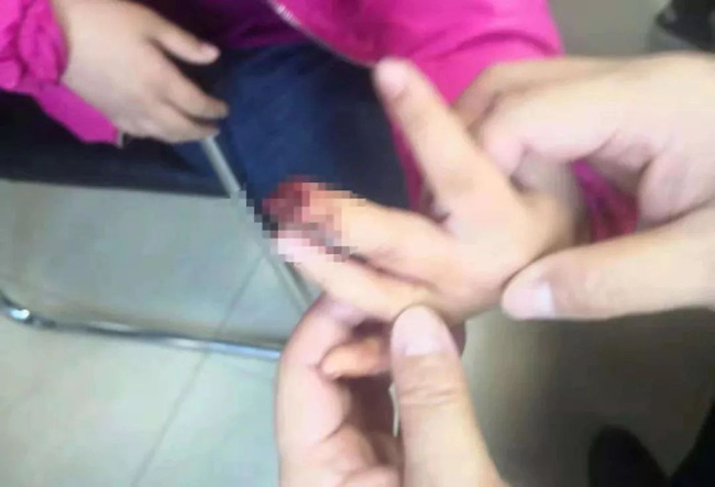 Bé gái 9 tuổi phải cưa ngón tay vì cách sơ cứu sai lầm của bà nội sau khi bị kẹt tay vào cửa-1