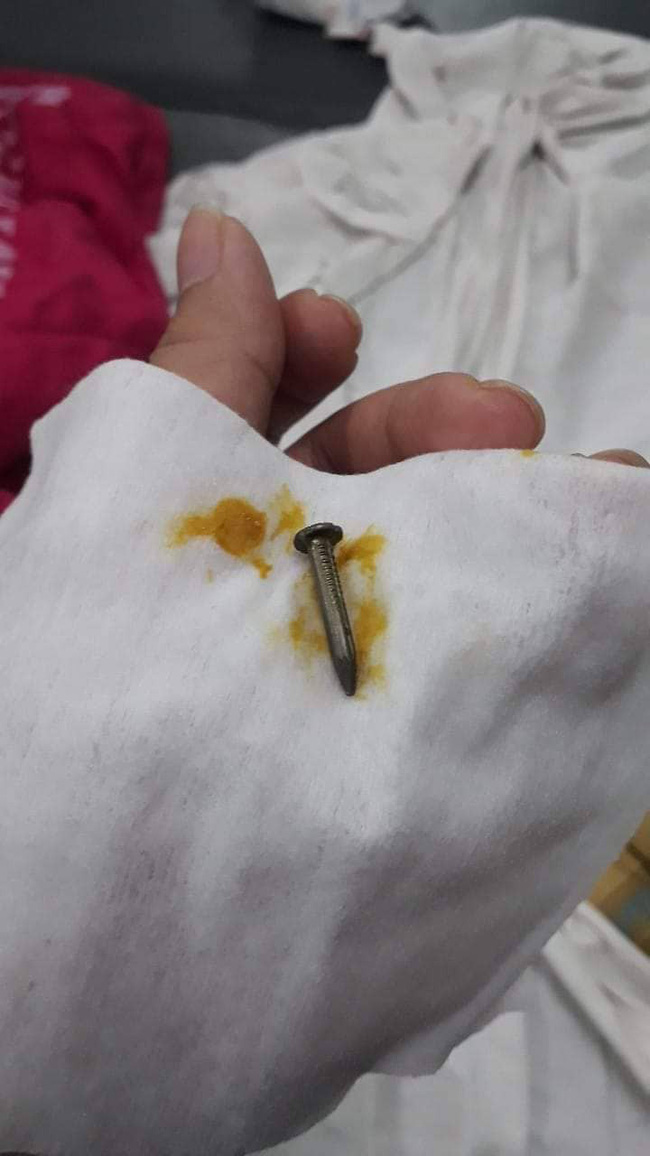 Anh trai 2 tuổi đút cho em ăn, mẹ thấy con ọe tức tốc đưa đi viện và hốt hoảng khi nhìn kết quả X-quang-5