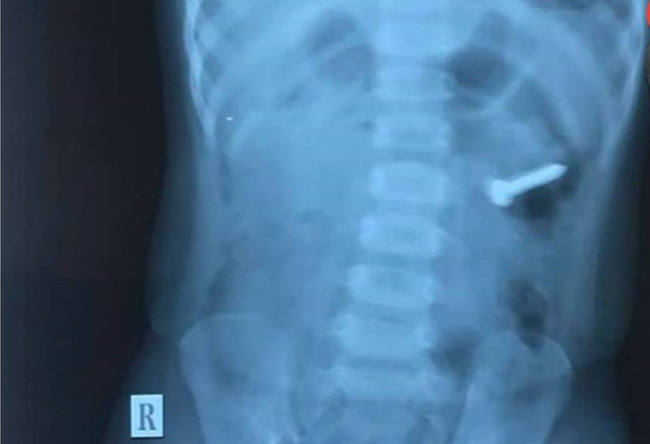 Anh trai 2 tuổi đút cho em ăn, mẹ thấy con ọe tức tốc đưa đi viện và hốt hoảng khi nhìn kết quả X-quang-2