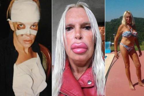 Những con thiêu thân nghiện dao kéo đến tàn tạ nhan sắc: Đừng mù quáng như họ!-1