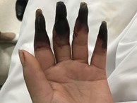 Dọn nhà, người phụ nữ bị hoại tử 8 ngón tay đen sì: Triệu chứng bất thường mọi người phải hết sức cảnh giác