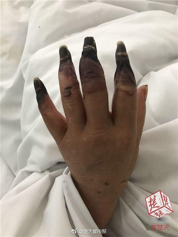 Dọn nhà, người phụ nữ bị hoại tử 8 ngón tay đen sì: Triệu chứng bất thường mọi người phải hết sức cảnh giác-3