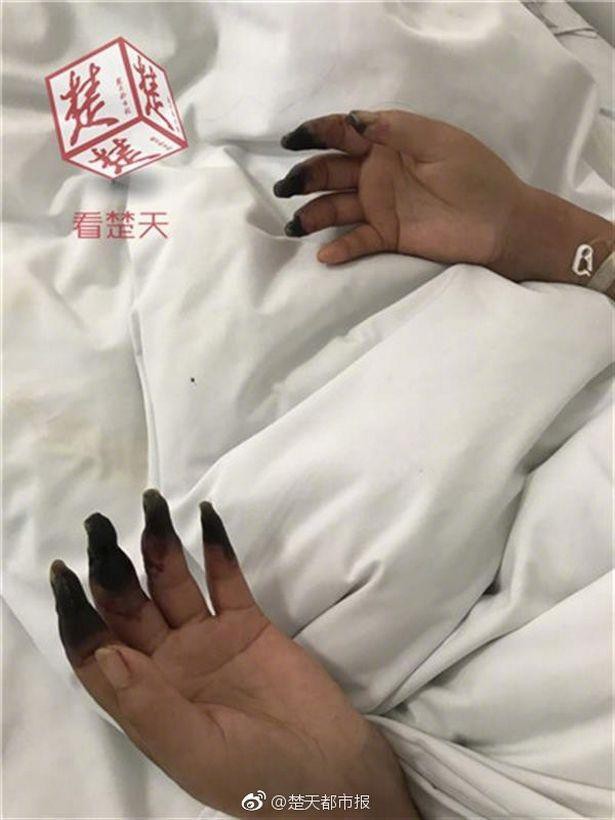 Dọn nhà, người phụ nữ bị hoại tử 8 ngón tay đen sì: Triệu chứng bất thường mọi người phải hết sức cảnh giác-1