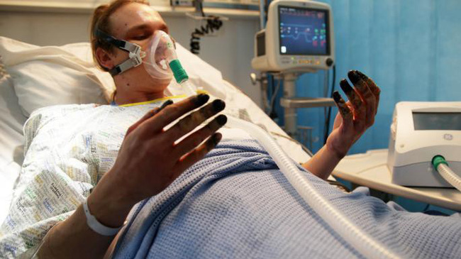 Dọn nhà, người phụ nữ bị hoại tử 8 ngón tay đen sì: Triệu chứng bất thường mọi người phải hết sức cảnh giác-4