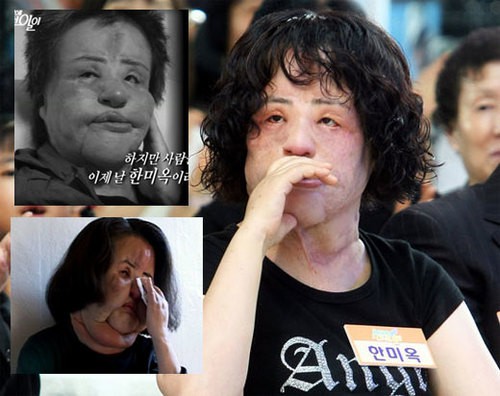 Thảm hoạ dao kéo Han Mi Ok qua đời ở tuổi 57: Thời trẻ điên cuồng thẩm mỹ, mua silicon, dầu ăn ở chợ đen về tự tiêm-5
