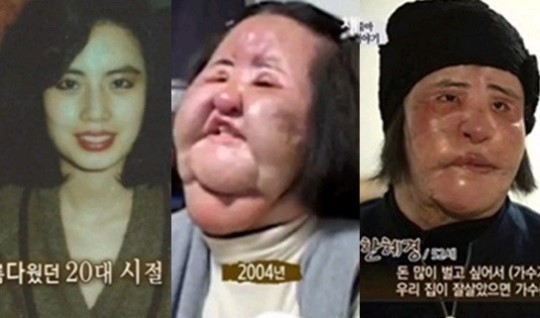 Thảm hoạ dao kéo Han Mi Ok qua đời ở tuổi 57: Thời trẻ điên cuồng thẩm mỹ, mua silicon, dầu ăn ở chợ đen về tự tiêm-3