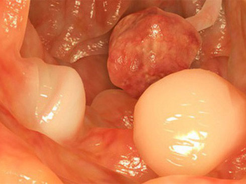 5 việc làm để ngăn chặn nguy cơ mắc ung thư trực tràng: Đừng để mầm bệnh lớn rồi mới biết-4