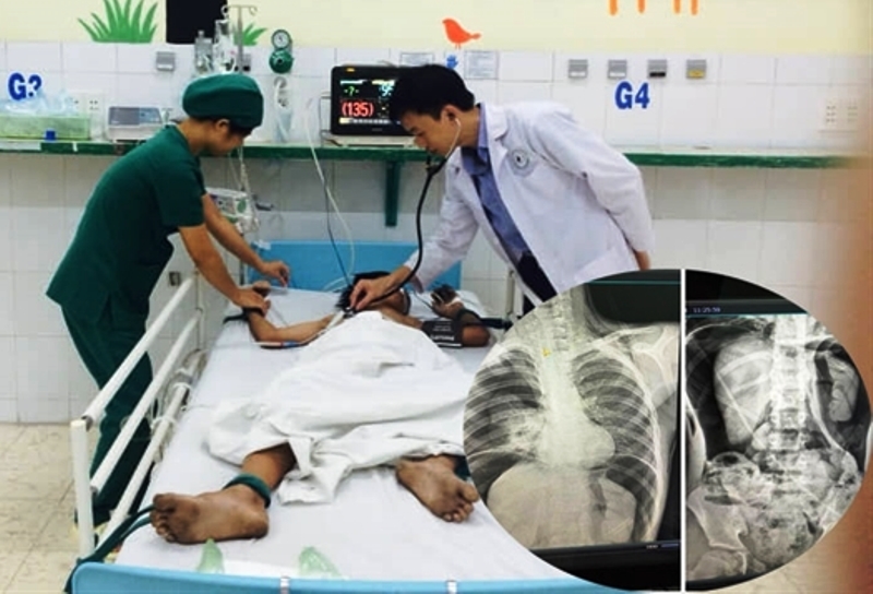 Bé trai vỡ đại tràng, nguy kịch vì bạn bơm hơi vào hậu môn-1