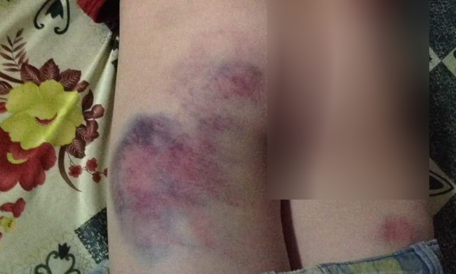 Cô giáo chủ nhiệm tiểu học đánh bé trai bầm tím mông vì không viết được bài-1