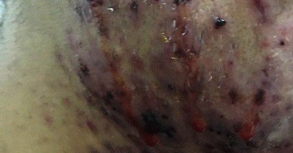 Bôi kem trộn, mặt thiếu nữ sưng vù, chi chít mụn mủ chưa từng thấy-1