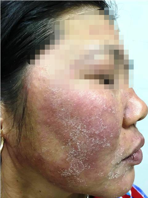 Bôi kem trộn, mặt thiếu nữ sưng vù, chi chít mụn mủ chưa từng thấy-4