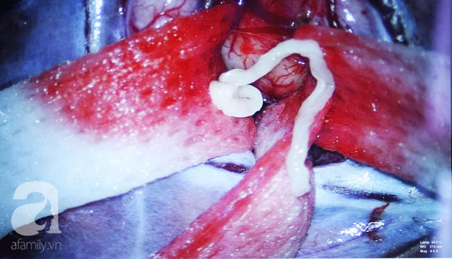 Cảnh báo: Ai hay ăn gỏi và rau sống, coi chừng bị ký sinh tấn công não nguy kịch như người đàn ông này-2