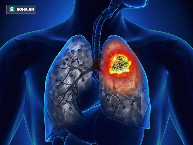 Hơn 20.000 người Việt tử vong do ung thư phổi mỗi năm: Phát hiện bệnh sớm để sống lâu hơn-1