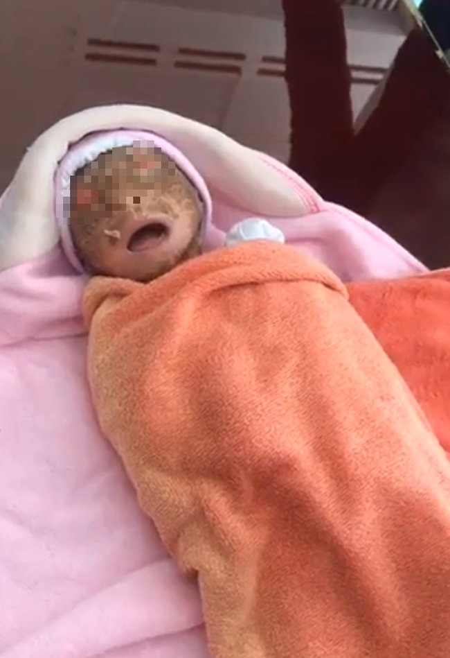 Bé trai chưa đầy 1 tháng tuổi, người đầy vảy ngứa như da trăn bị bố mẹ bỏ rơi ngoài đường-3