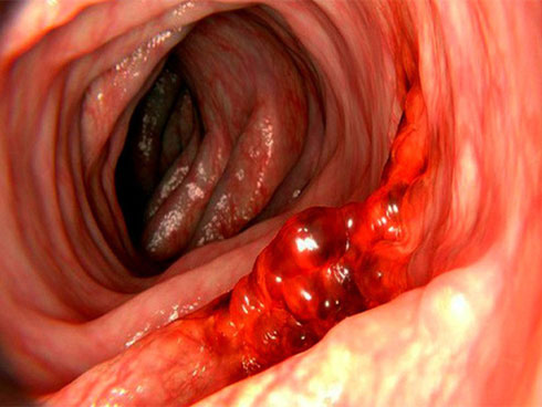 5 anh em nhưng 4 người bị ung thư dạ dày, sát thủ ở ngay trong chính bữa ăn-2
