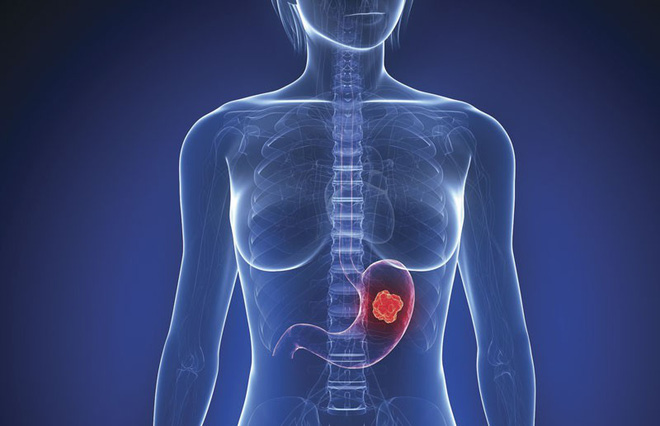 Ung thư dạ dày có tỷ lệ tử vong cao: Làm đủ 4 việc để sớm ngăn chặn mầm bệnh sinh sôi-1