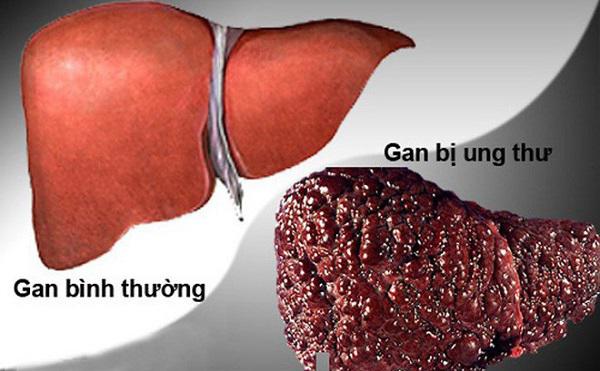 Chuyên gia ung bướu vạch mặt nguyên nhân khiến nhiều người mắc bệnh ung thư số 1 Việt Nam-1