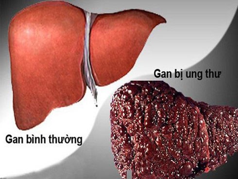 Chuyên gia ung bướu vạch mặt nguyên nhân khiến nhiều người mắc bệnh ung thư số 1 Việt Nam