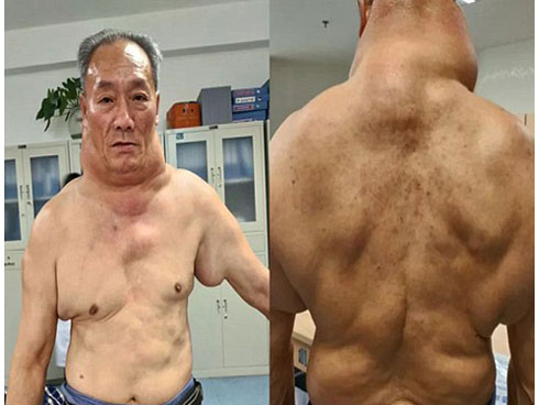 Uống rượu nhiều năm, 3 người đàn ông mắc bệnh lạ, khối u khủng mọc chi chít-4