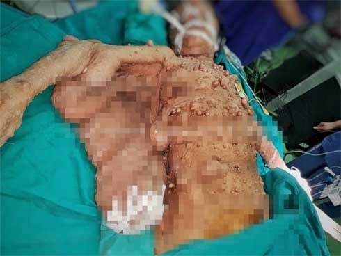 Phẫu thuật cứu người phụ nữ có hàng trăm khối u xõa như cánh đại bàng