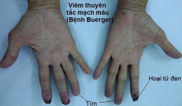 Ngón tay và ngón chân của người ông này bỗng chuyển sang màu đen sì - dấu hiệu cảnh báo bệnh nguy hiểm-4