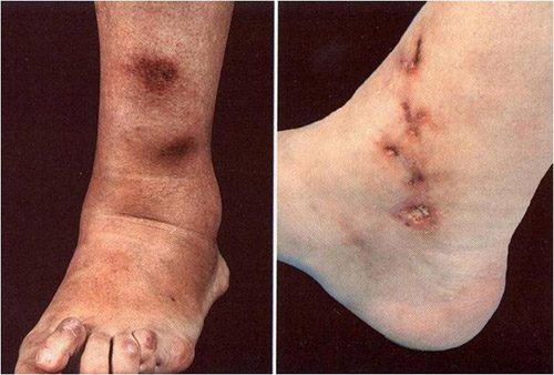 Ngón tay và ngón chân của người ông này bỗng chuyển sang màu đen sì - dấu hiệu cảnh báo bệnh nguy hiểm-5