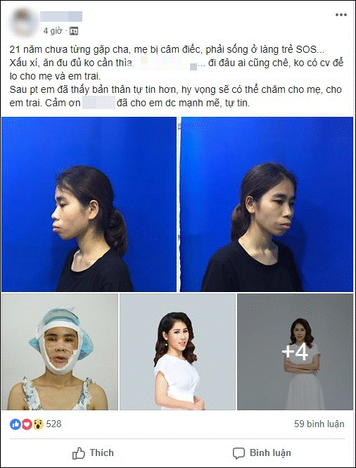 Bị chê ăn đu đủ không cần thìa, cô gái quyết tâm lột xác và thành quả bất ngờ khiến mẹ chỉ có thể nhận ra con gái qua vết sẹo-1