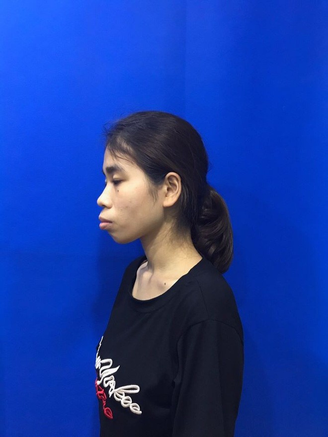 Bị chê ăn đu đủ không cần thìa, cô gái quyết tâm lột xác và thành quả bất ngờ khiến mẹ chỉ có thể nhận ra con gái qua vết sẹo-2