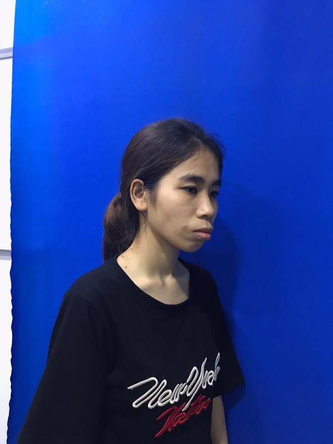 Bị chê ăn đu đủ không cần thìa, cô gái quyết tâm lột xác và thành quả bất ngờ khiến mẹ chỉ có thể nhận ra con gái qua vết sẹo-3