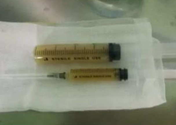 Con gái cảm sốt nhiều ngày, mẹ đưa đến bệnh viện thì phát hiện trong phổi có 600ml mủ và lời cảnh tỉnh về căn bệnh thường gặp ở trẻ-2