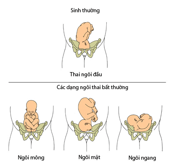 Tròn mắt xem bác sĩ dùng 2 tay xoay ngôi thai từ ngôi ngược thành ngôi thuận chỉ trong chưa đầy 1 phút-6
