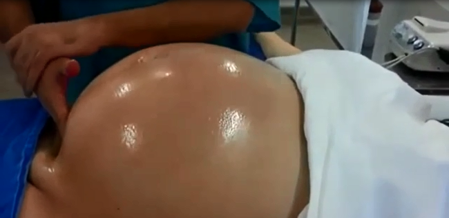 Tròn mắt xem bác sĩ dùng 2 tay xoay ngôi thai từ ngôi ngược thành ngôi thuận chỉ trong chưa đầy 1 phút-1