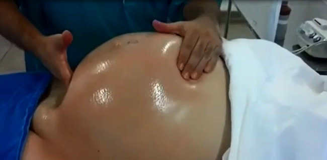 Tròn mắt xem bác sĩ dùng 2 tay xoay ngôi thai từ ngôi ngược thành ngôi thuận chỉ trong chưa đầy 1 phút-2