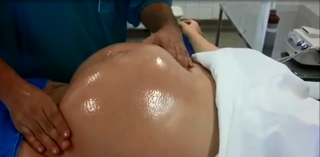 Tròn mắt xem bác sĩ dùng 2 tay xoay ngôi thai từ ngôi ngược thành ngôi thuận chỉ trong chưa đầy 1 phút-3