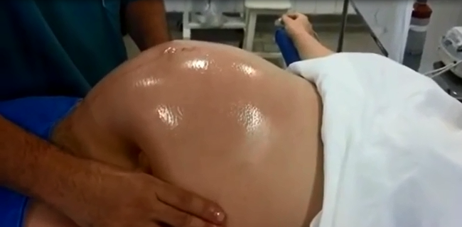 Tròn mắt xem bác sĩ dùng 2 tay xoay ngôi thai từ ngôi ngược thành ngôi thuận chỉ trong chưa đầy 1 phút-4