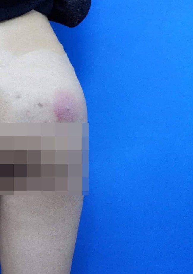 Cô gái 25 tuổi bị nhiễm trùng vì tự bơm silicon vào mông tại nhà: Khuyến báo không thừa của bác sĩ-1