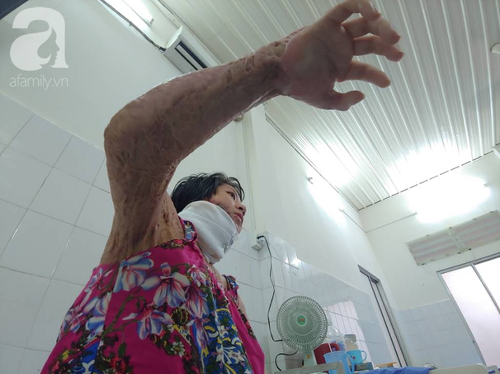 Thương tâm mẹ trẻ bị lửa xăng đốt nát da thịt, một mình chống chọi đau đớn trong viện: Giờ tôi chỉ sống vì con”-10