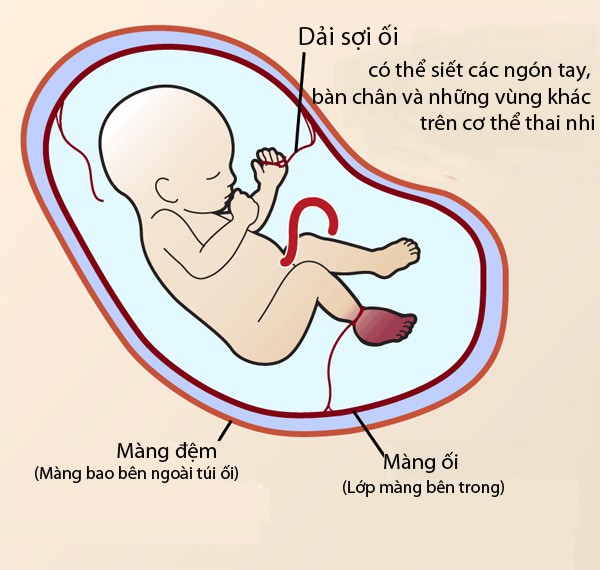 Con vừa chào đời mẹ hốt hoảng khi bác sĩ thông báo phải cắt bỏ chân con vì hội chứng thai kỳ ít người biết-3