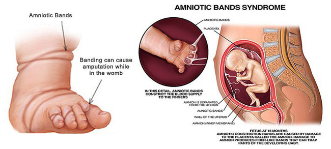 Con vừa chào đời mẹ hốt hoảng khi bác sĩ thông báo phải cắt bỏ chân con vì hội chứng thai kỳ ít người biết-4